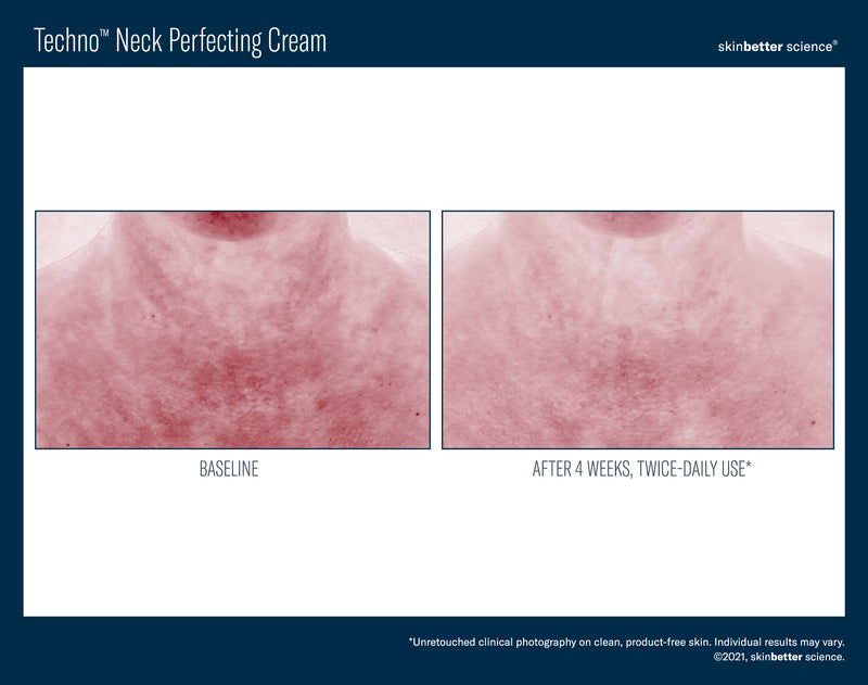 Skinbetter | Techno Neck Perfecting Cream